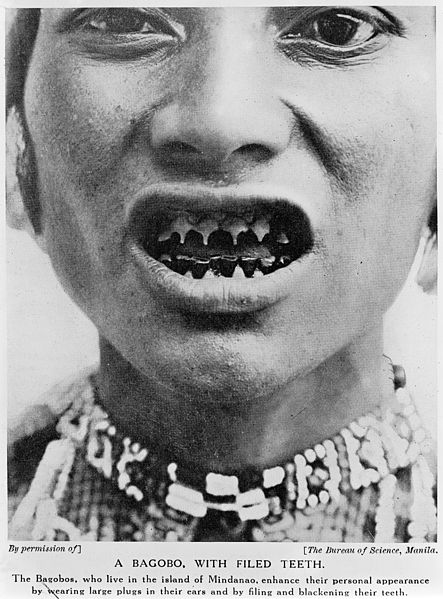 Limado de dientes Limado de dientes