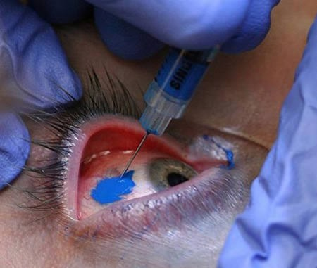 Tatuaje en el ojo Tatuaje en el ojo