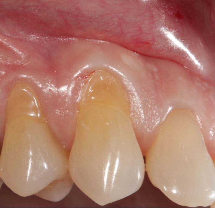 Enfermedad periodontal