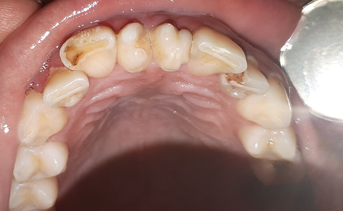 Caries