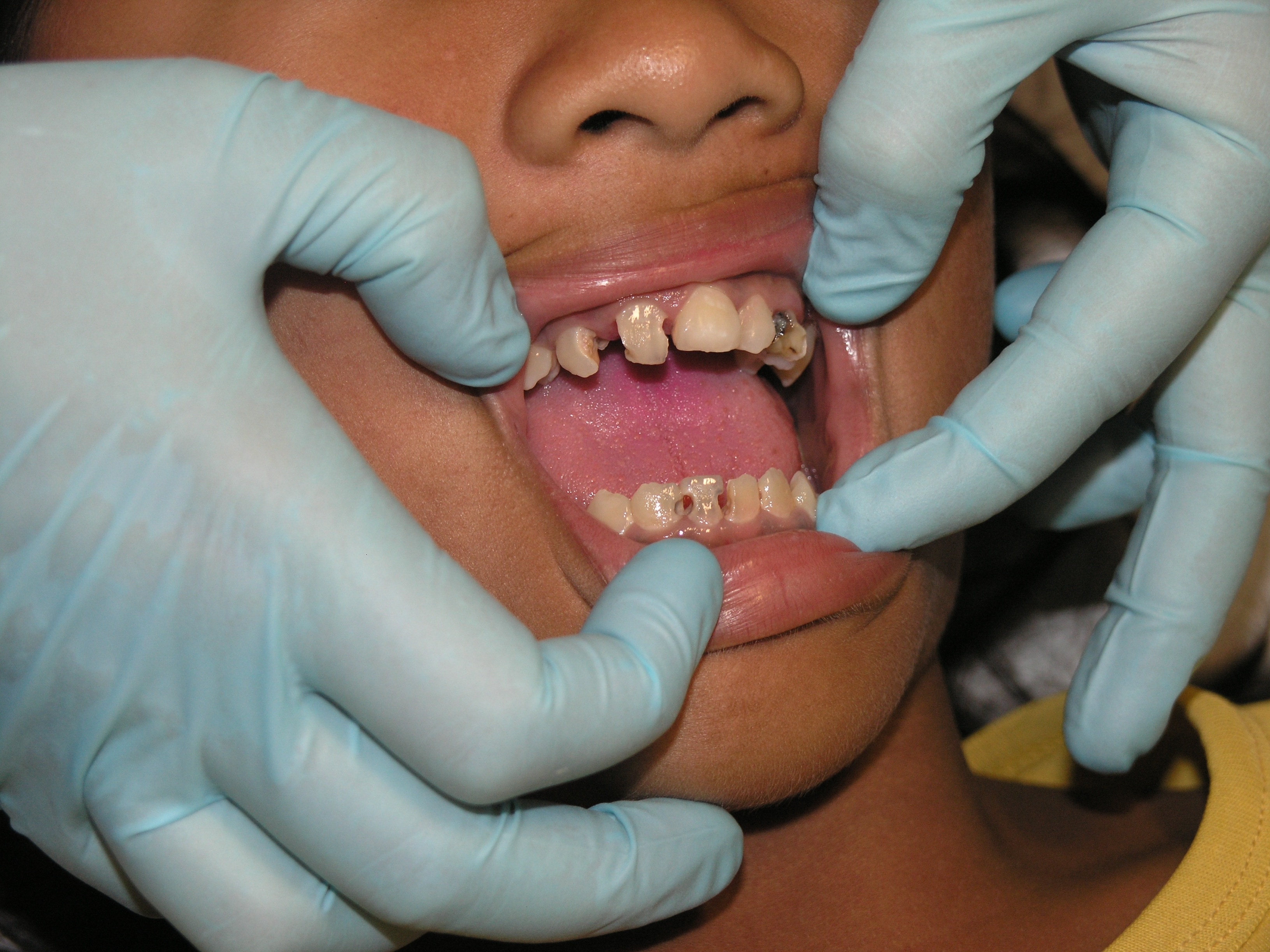 Dientes con caries